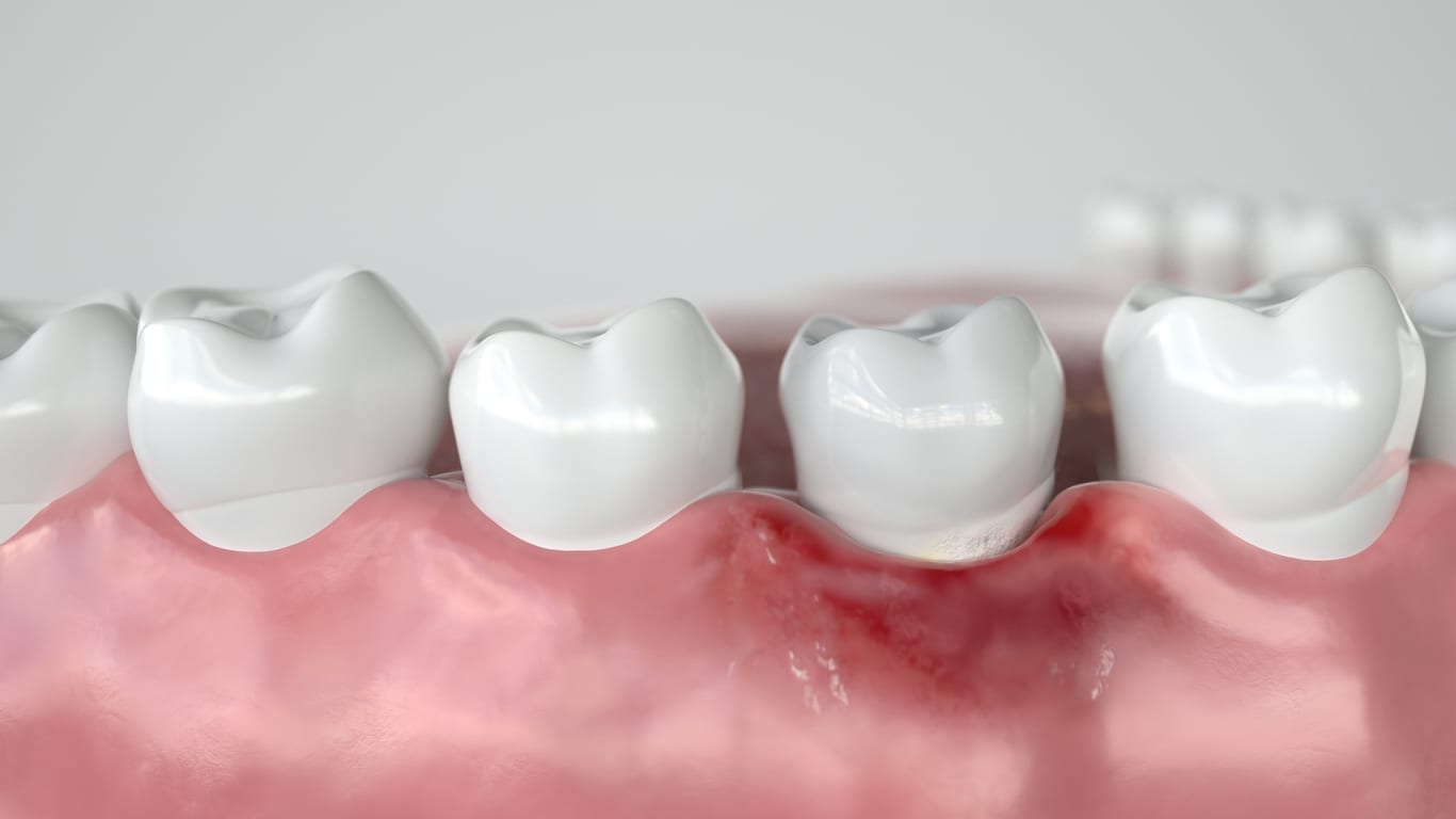 Periodontoloji – Diş Eti Hastalıkları Tedavisi - DentOstim